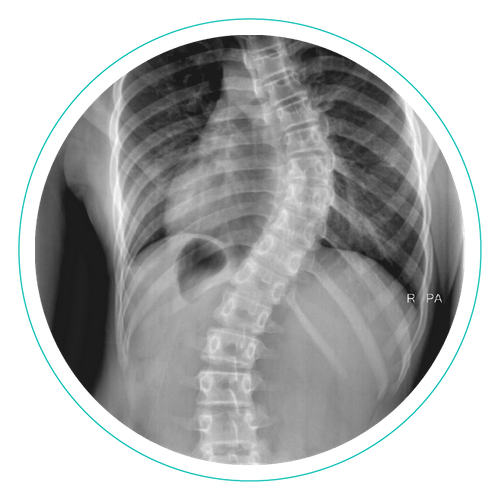Scoliosis Treatment Calgary