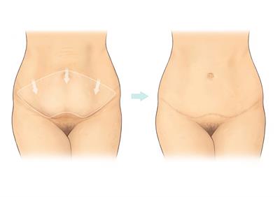 abdominoplastika cena