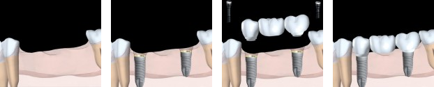 Dental Implants