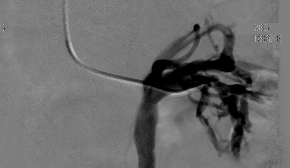 Pelvic Venous Congestion Secondary to Nutcracker Phenomena Michael