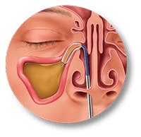 Dilate & Restore - Balloon Sinuplasty procedure