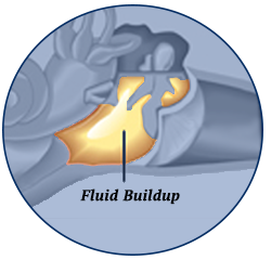 Eustachian Tube Dysfunction