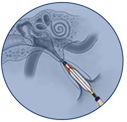 ETD treatment - Dilate
