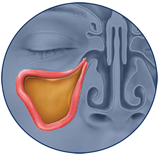 Sinus infection symptoms