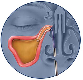 Balloon Sinuplasty Procedure