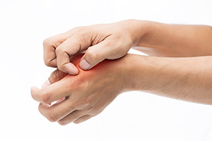 Itching, Rash, Welts, Allergic Reaction
