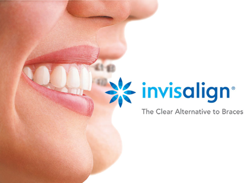 What Is Invisalign® / Ratoath Orthodontics / Co. Meath