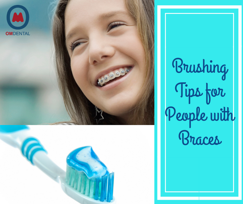 Tips for brushing teeth if you have braces on