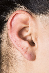 Repair of Earring Hole, Earlobe