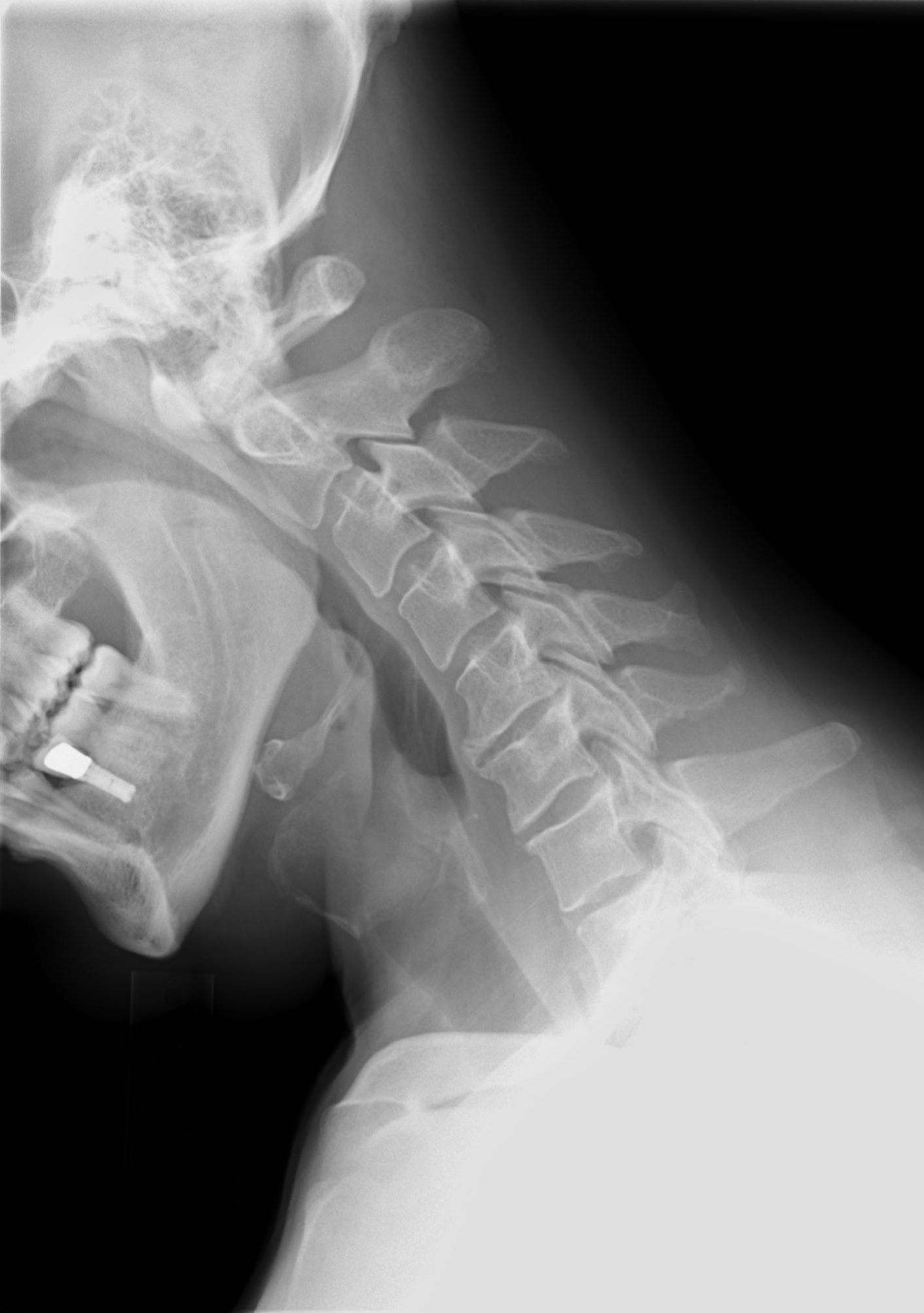 Neck Injury Treatment