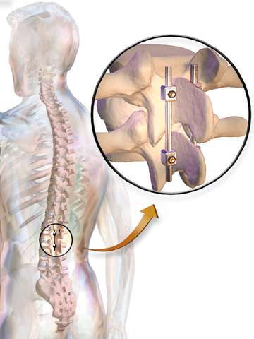 Leg-Pain-Caused-by-Spine