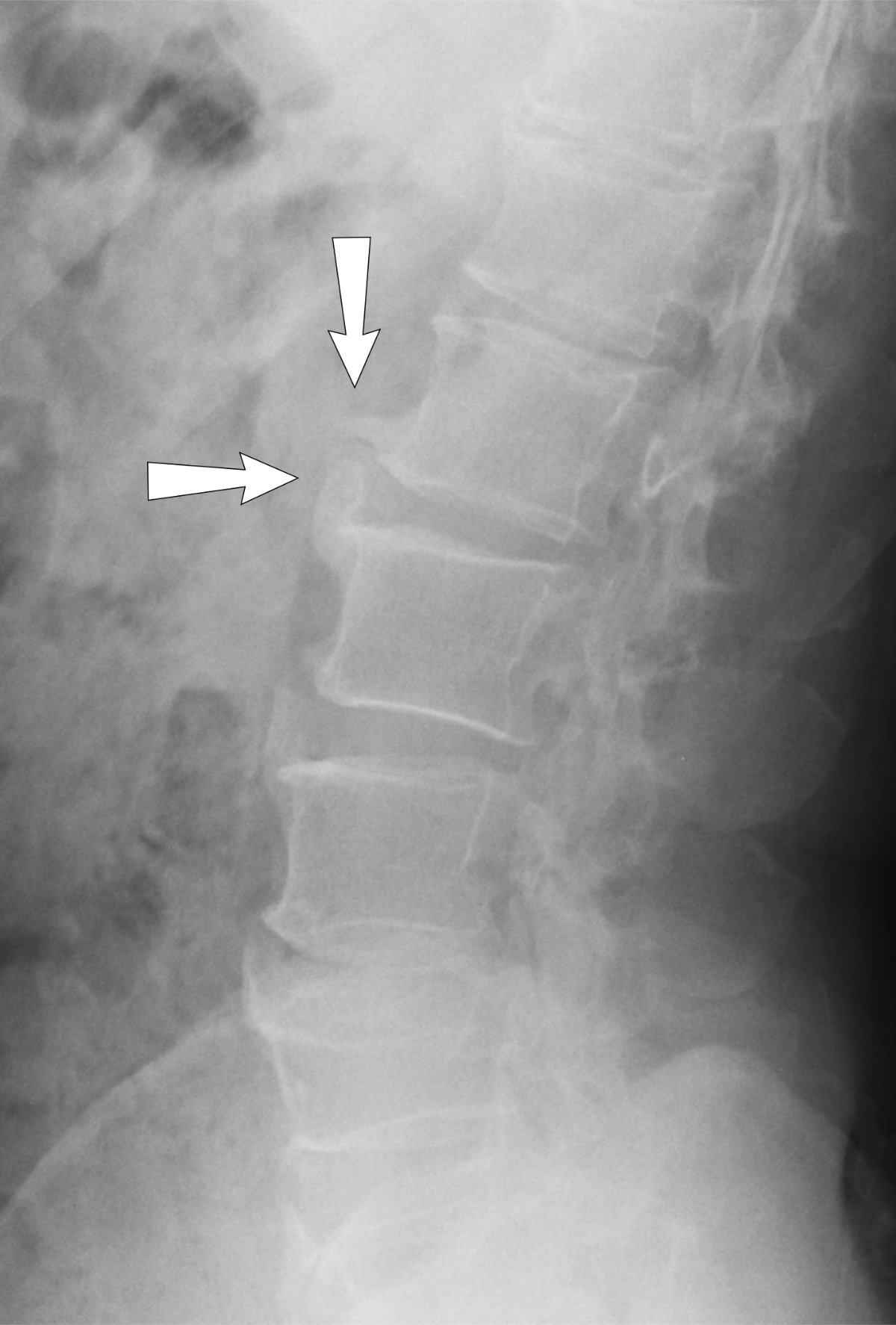 Leg-Pain-Caused-By-Back-Problem