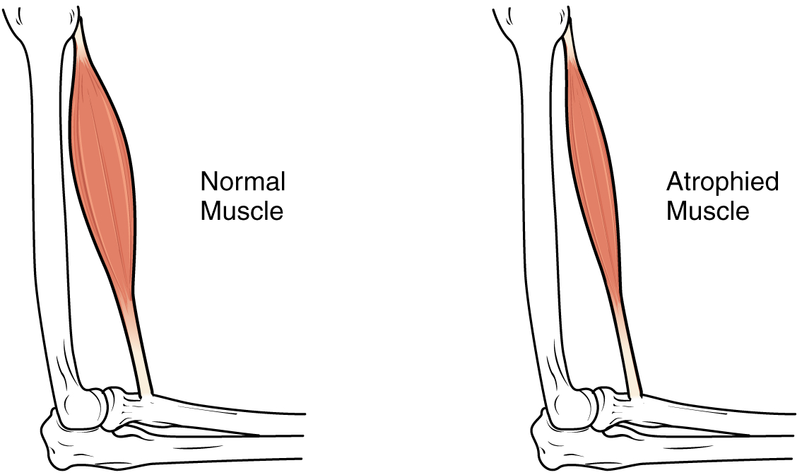 Muscle-atrophy