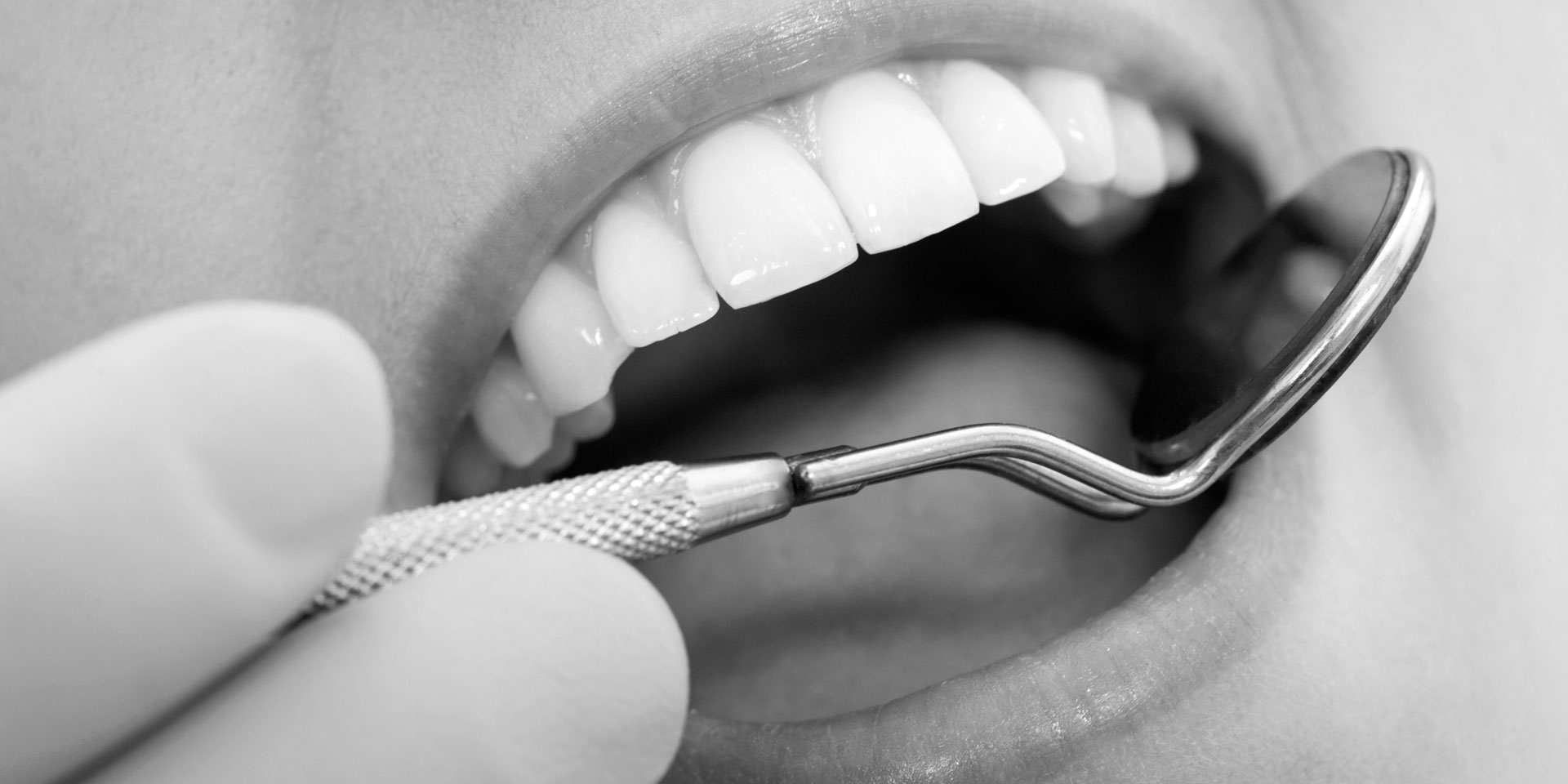 Composite Fillings Dayton Dental Collaborative Composite Fillings Dayton Dental Collaborative