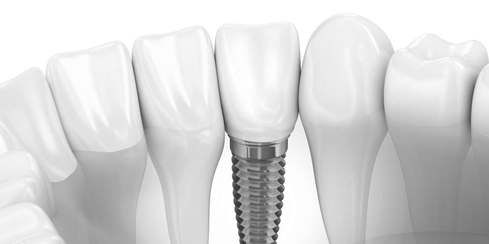 Dental Implants Dayton Dental Collaborative