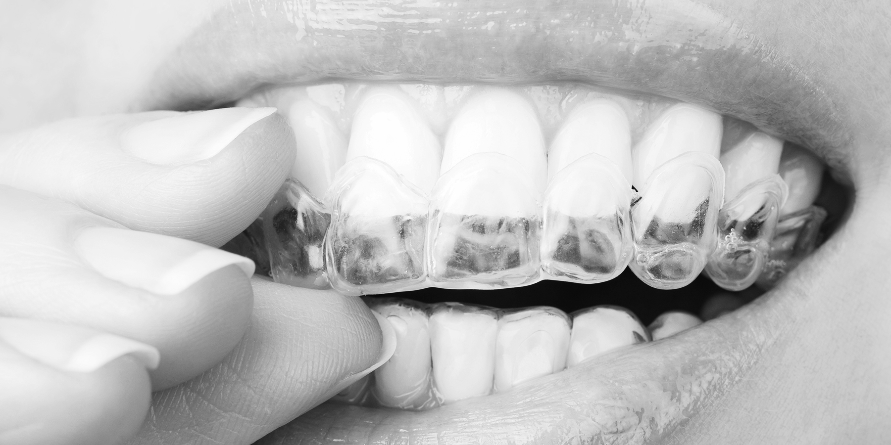 How Invisalign® Creates Beautifully Straight Smiles Dayton Dental