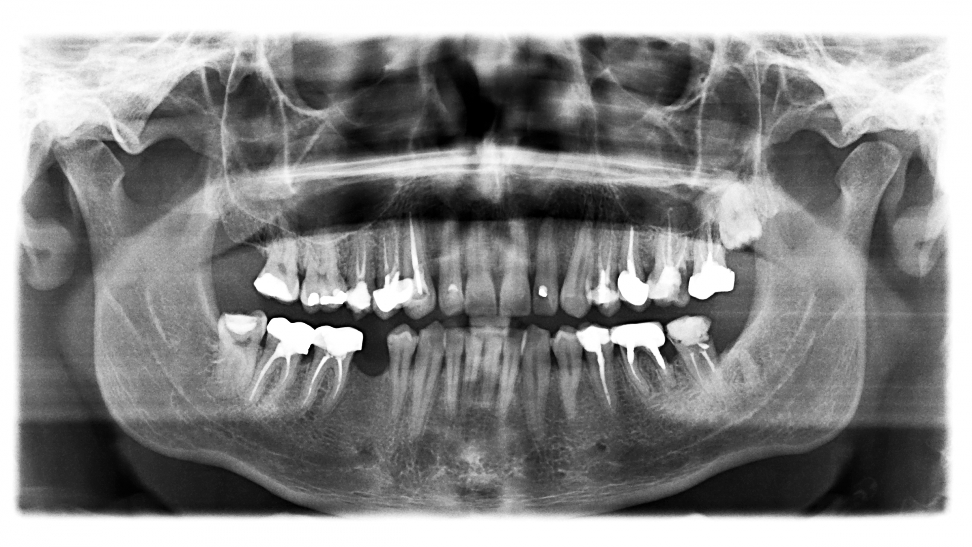 What You Need to Know About Digital & Conventional Dental Xrays
