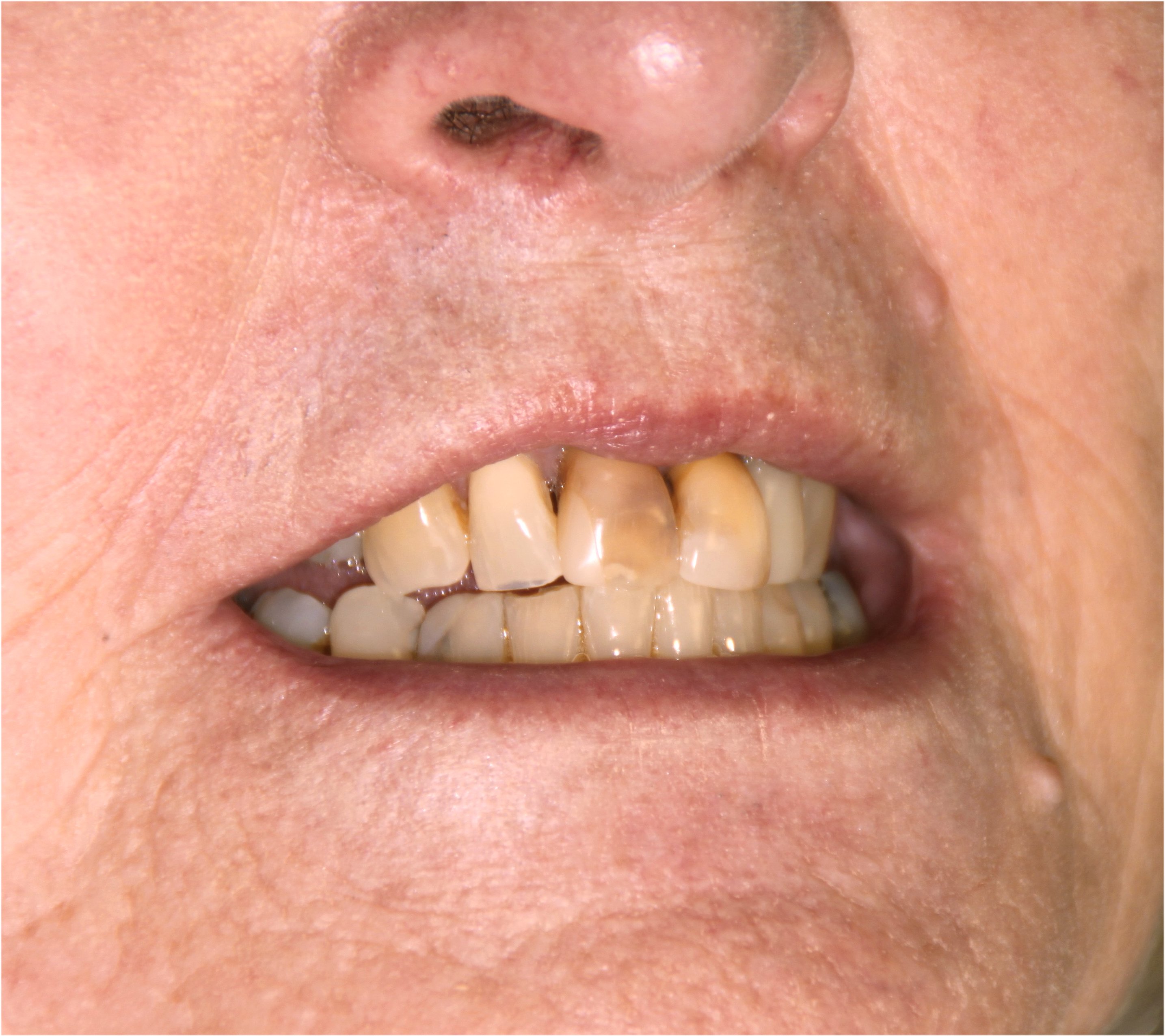 Edelweiss Veneers The Stafford Dental Practice