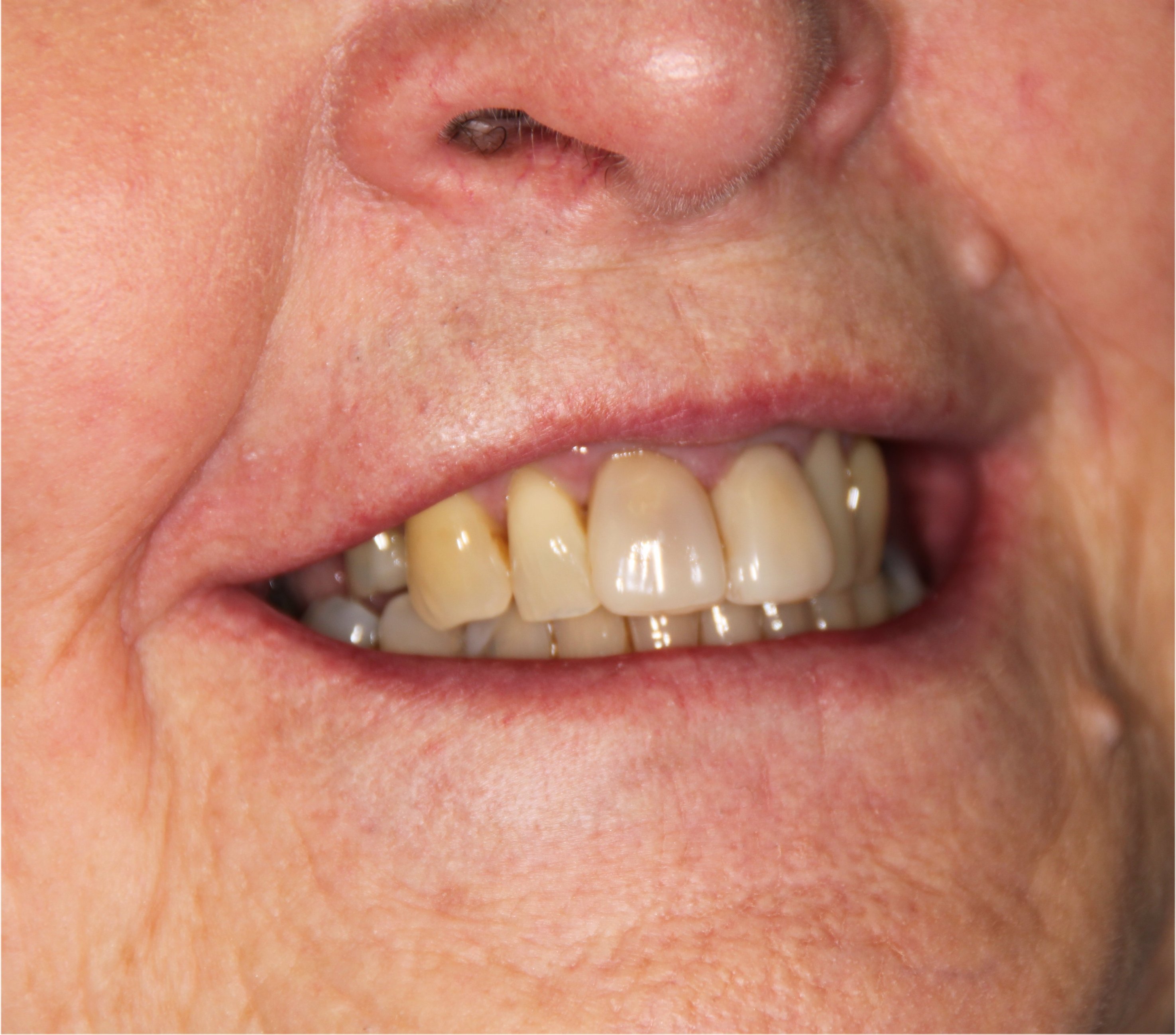 Edelweiss Veneers The Stafford Dental Practice