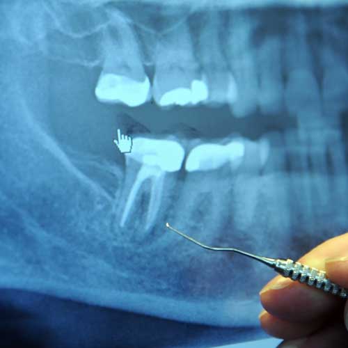 3 Advantages of Digital XRays Greentree Dental Group