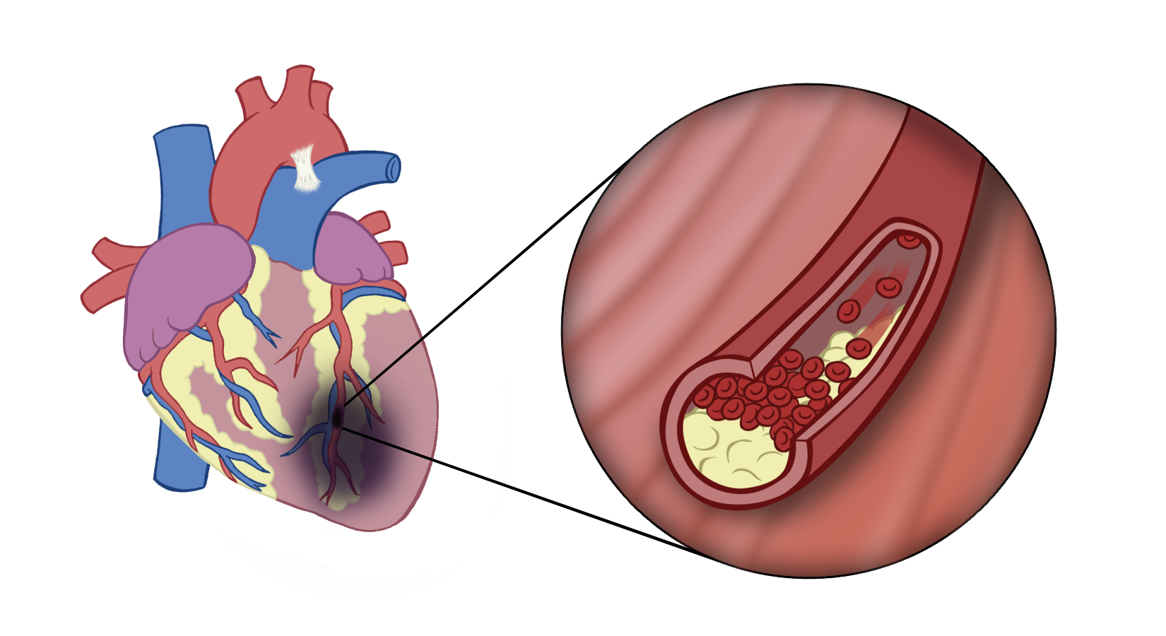 Plaque build up in the blood vessels of the heart