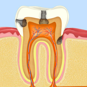 root canal treatment deep cavity in tooth