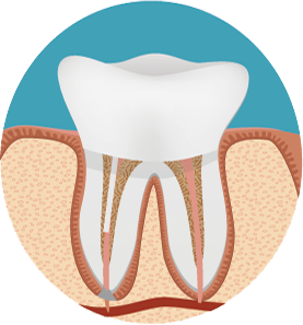 root canal with crown