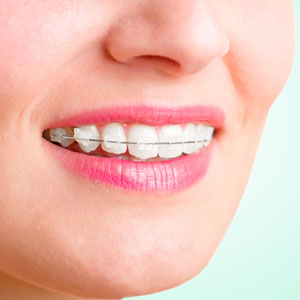 coloured ceramic braces orthodontics