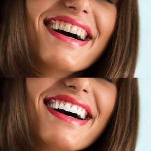 comparison of before and after teeth whitening