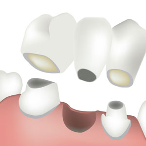 dental bridge procedure