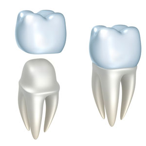 Dental crown procedure image