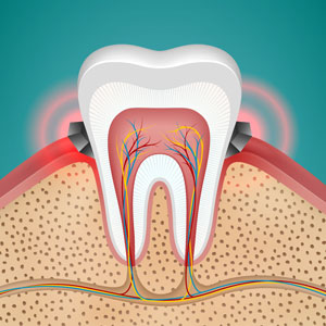 gum disease gingivitis in tooth