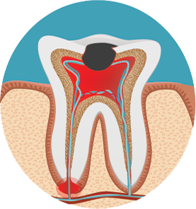 root canal treatment procedure
