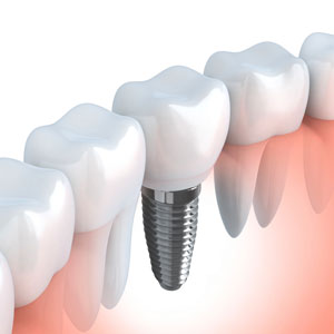 dentist implant surgery procedure