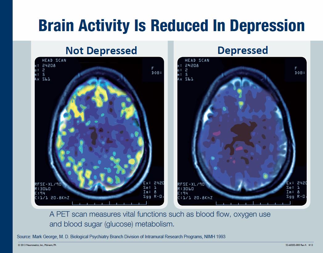 PET scans show the differences in brain function between brains with depression and brains without depression