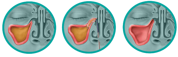 Balloon Sinuplasty Procedure