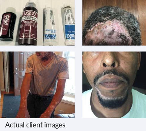 Disfigurement From Just For Men Skin Burns Scarring