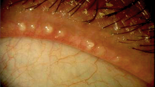 What Is Meibomian Gland Dysfunction Eyedeal Vision Explains Meibomian 