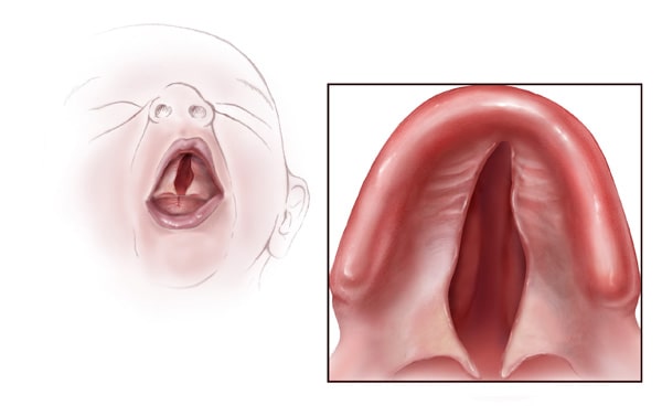 cleft palate