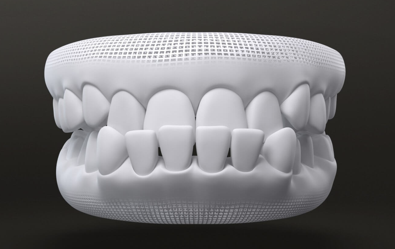 graph of underbite