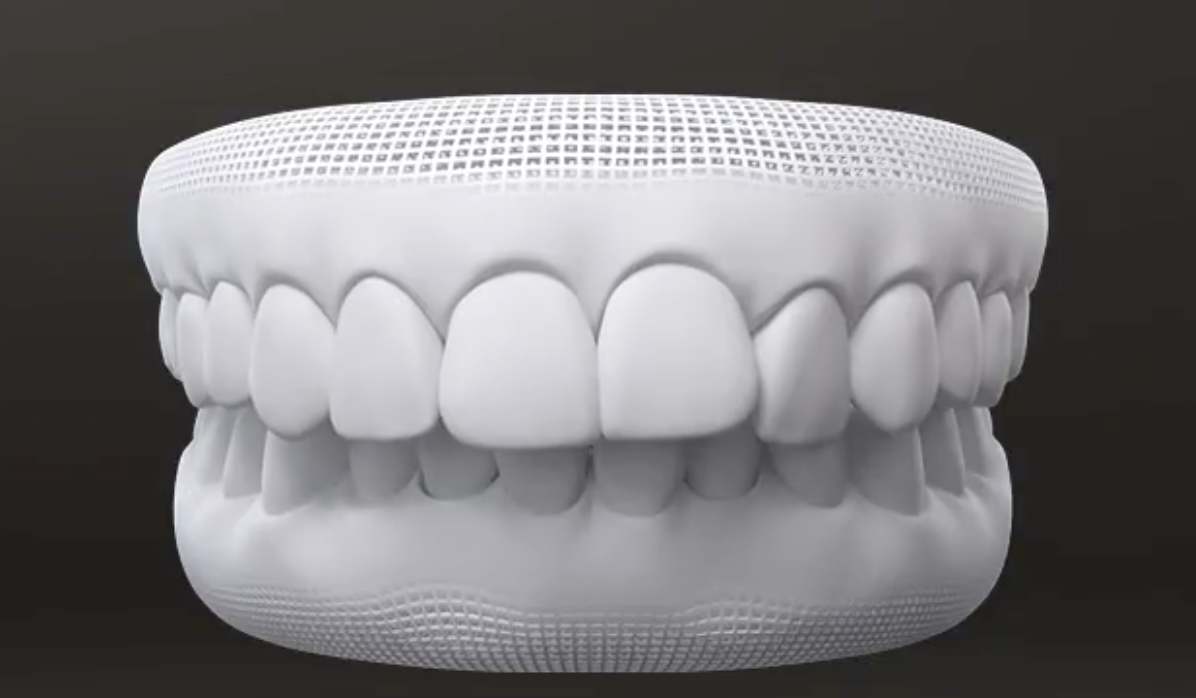 graph of overbite