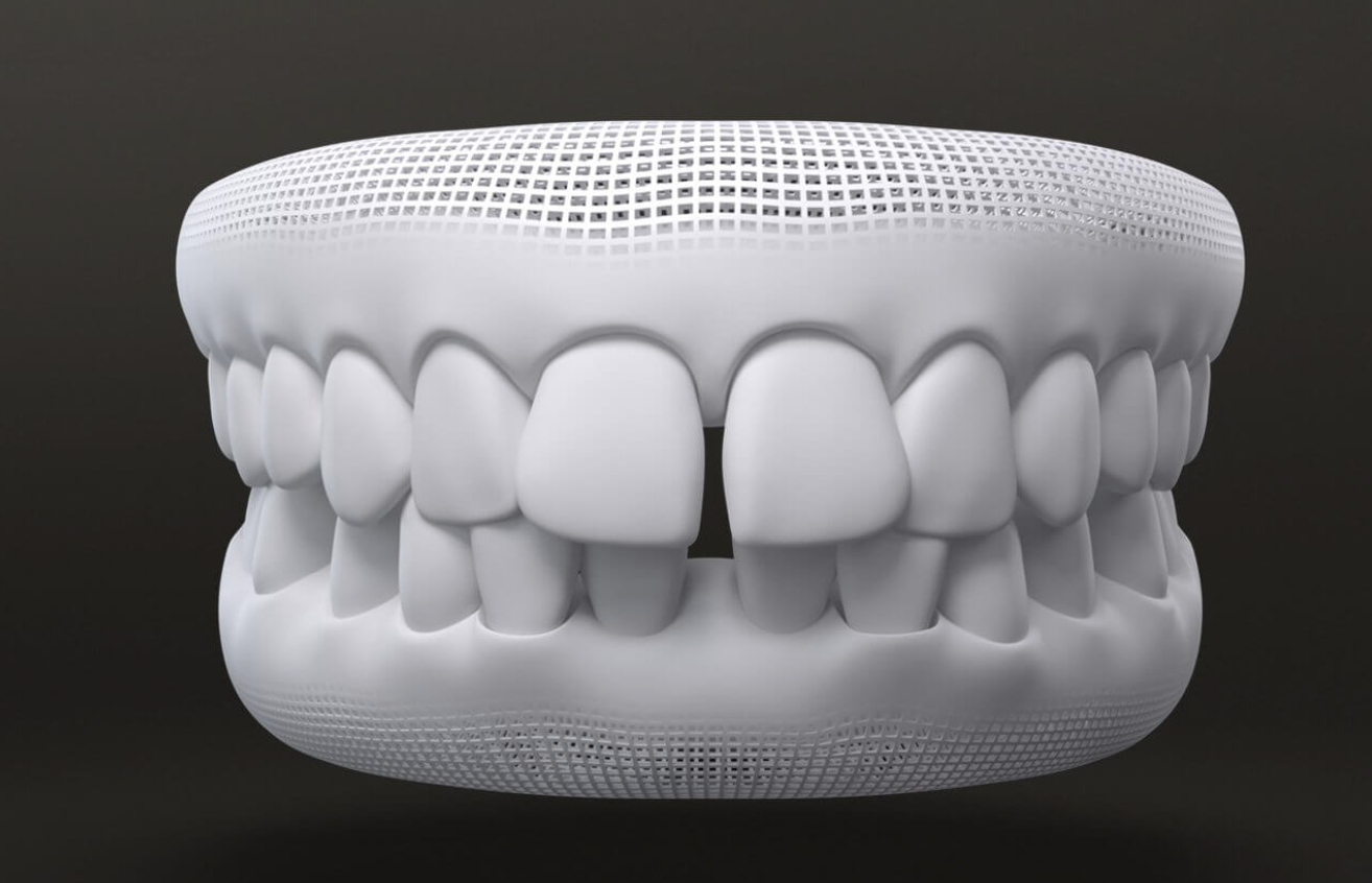 graph of gap teeth