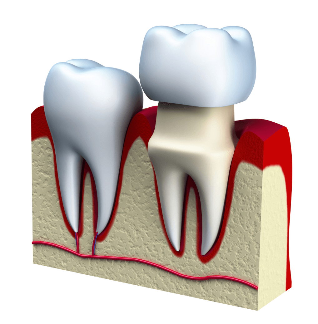 Dental Crowns Pittsburgh
