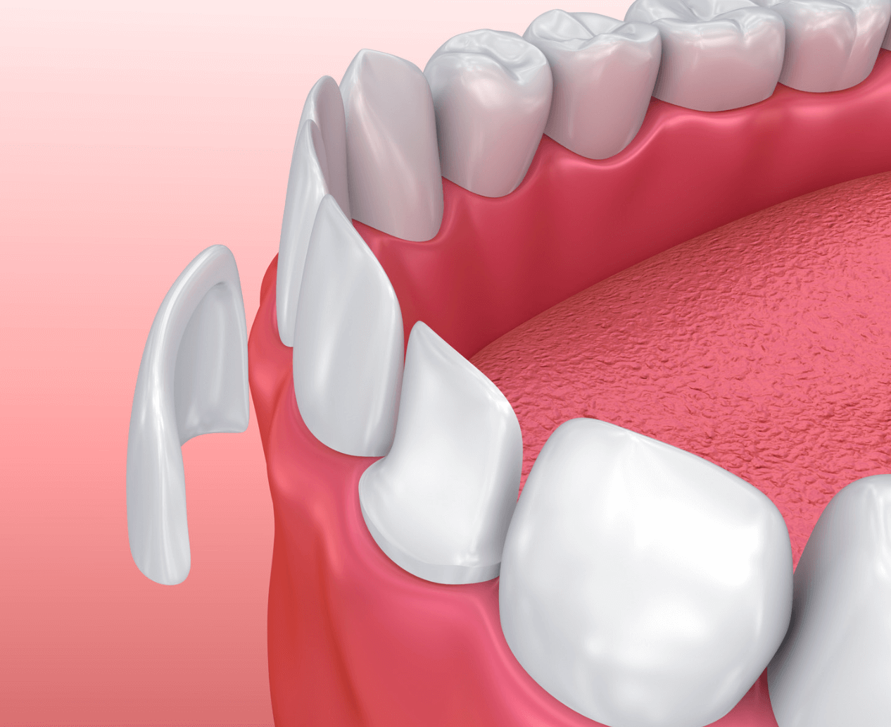 Pittsburgh Veneers
