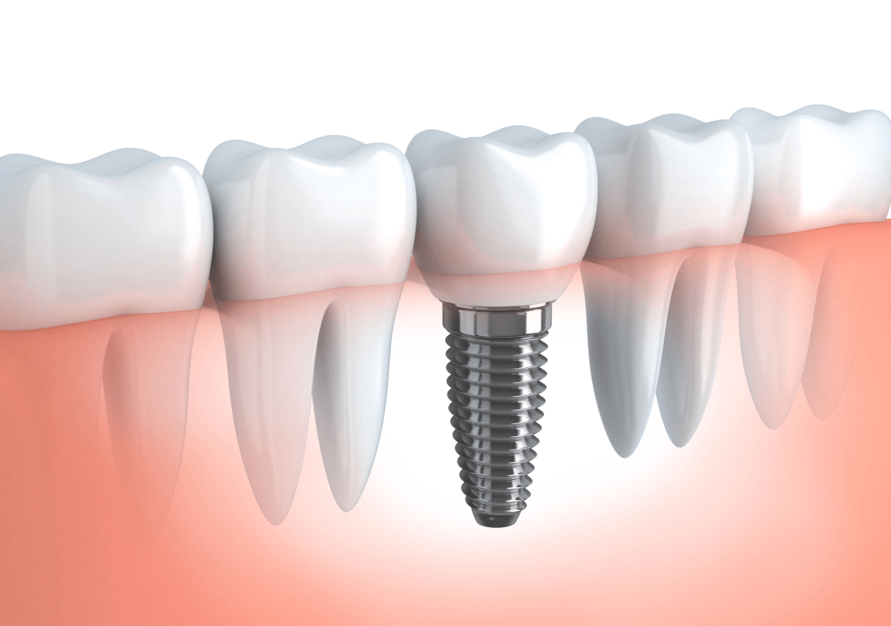 Dental Implants Pittsburgh