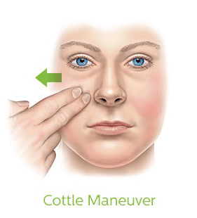Cottle's Maneuver is a simple self-test to measure your nasal flow.