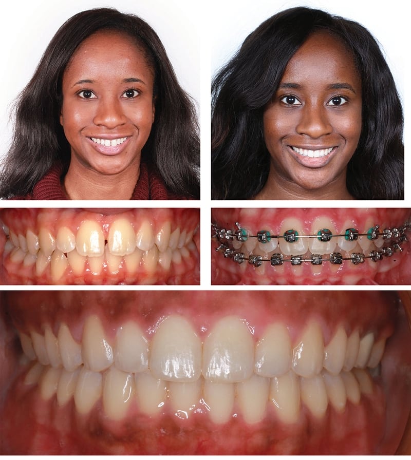 Orthodontics in Kansas City ,Gladstone Orthodontist ,Parkville