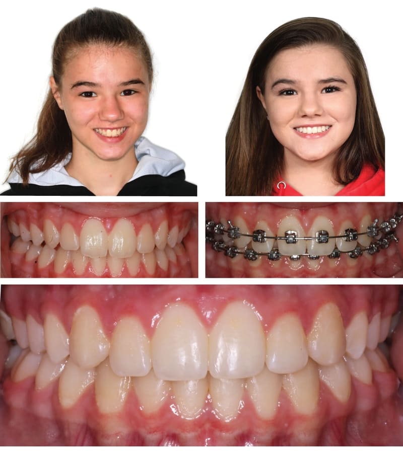 Orthodontics in Kansas City ,Gladstone Orthodontist ,Parkville