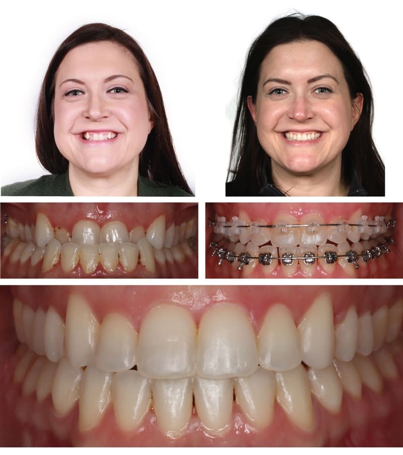 Orthodontics in Kansas City ,Gladstone Orthodontist ,Parkville