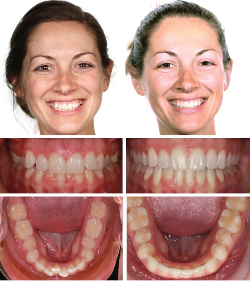 Invisalign in Platte City , Gladstone , Parkville , Invisalign in